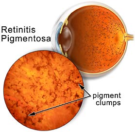 people with retinitis pigmentosa