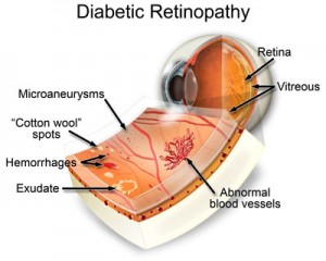 Diabetic Retinopathy: The Signs, Symptoms, and Solutions | Ocular  Prosthetics, Inc.