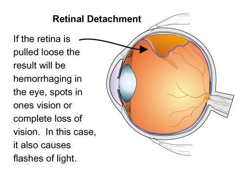 Prosthetic Eye Retinal Detachment Ocular Prosthetics Inc